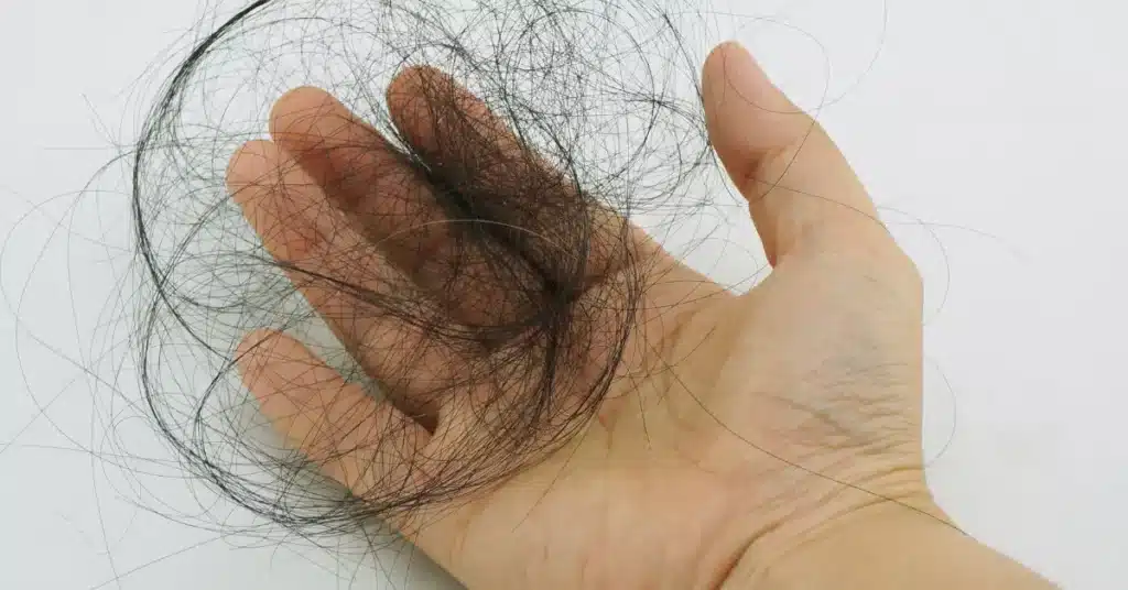 Alopecia in children