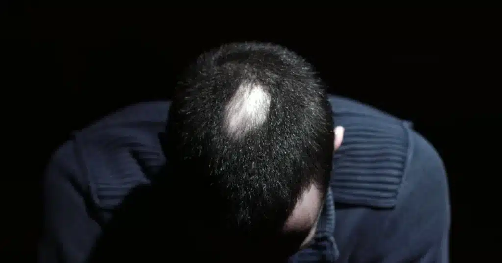 Bald patch due to Alopecia Areata