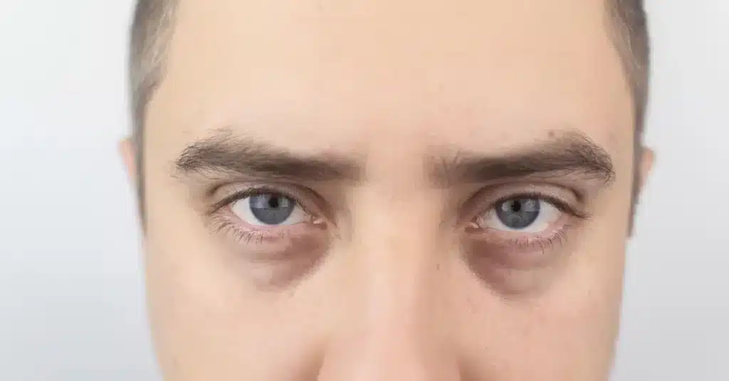 How to get rid of Puffy Eyes