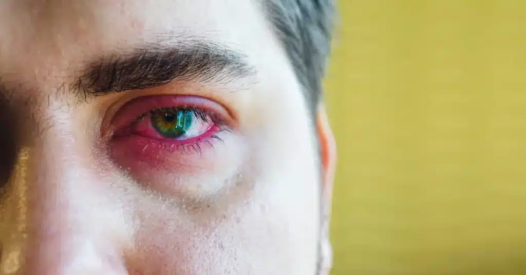 Hypothyroidism Puffy Eyes