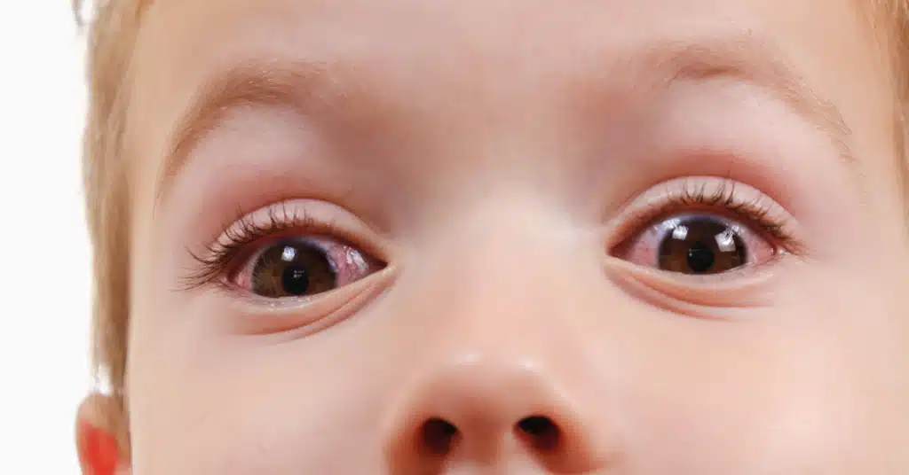 Conjunctivitis