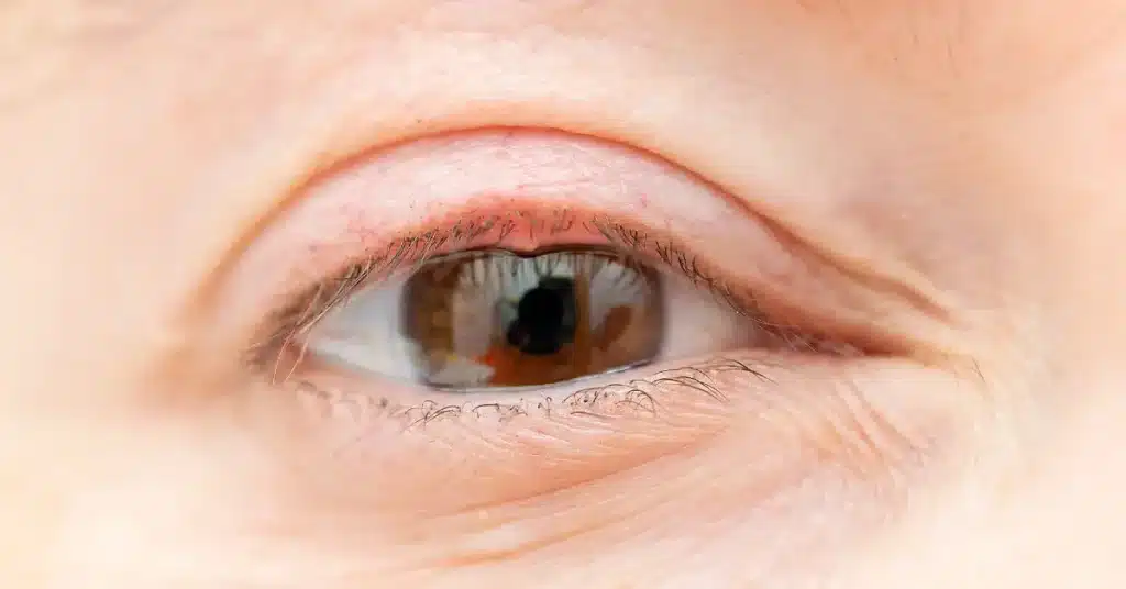 Bacterial Pink Eye Symptoms