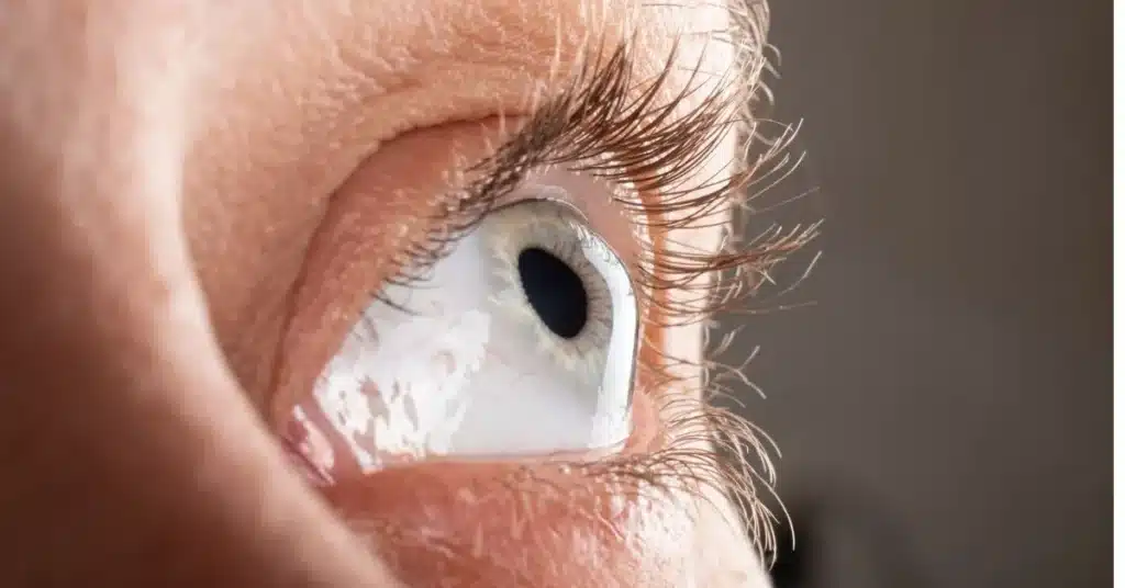 Corneal Ulcer Treatment