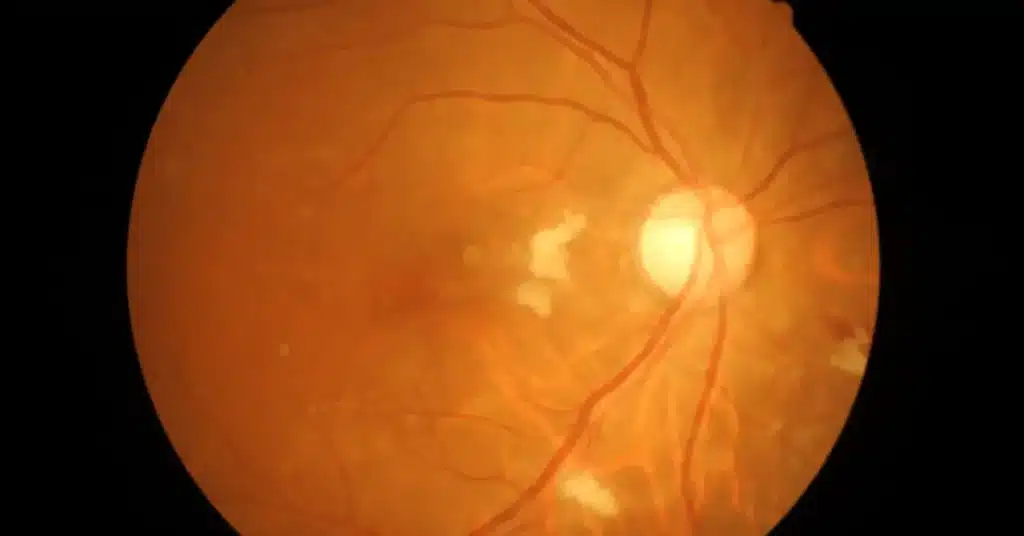 optic nerve inflammation