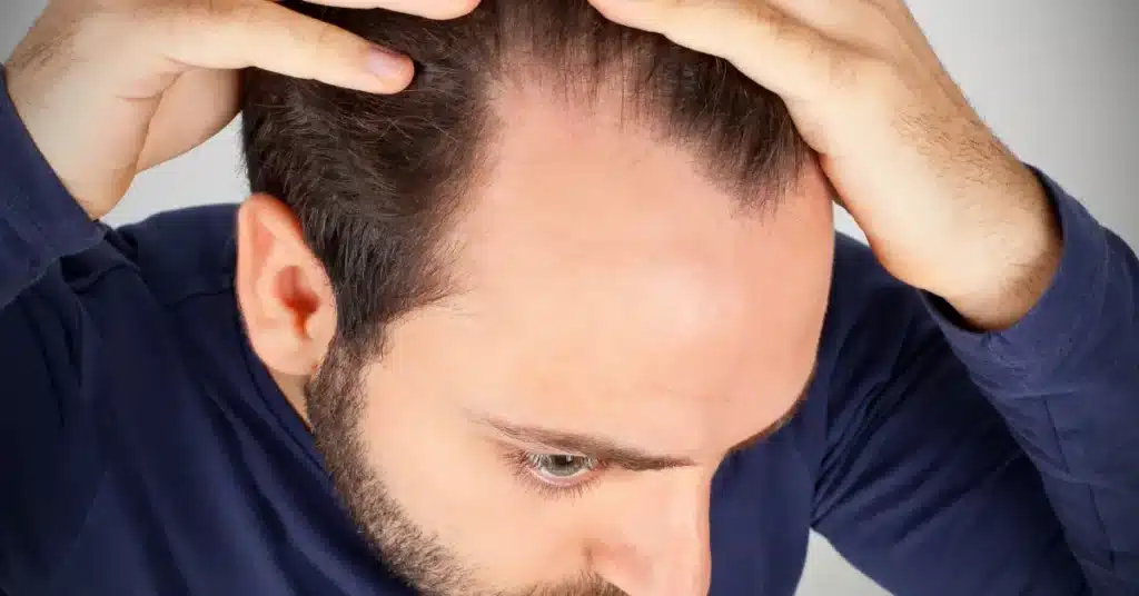Hair loss due to masturbation