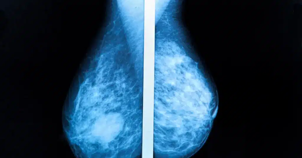 Mammography
