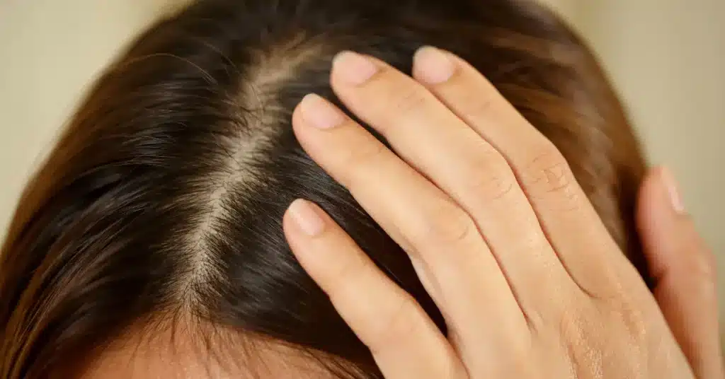 Scalp Infection