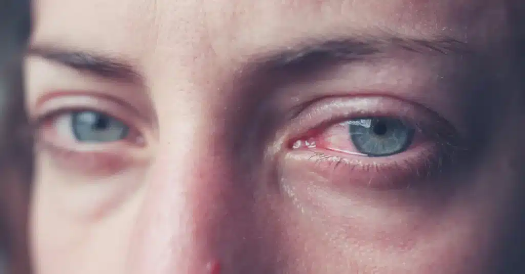 eye tearing