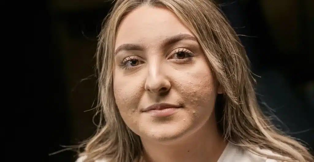 Acne - Norethindrone side effects