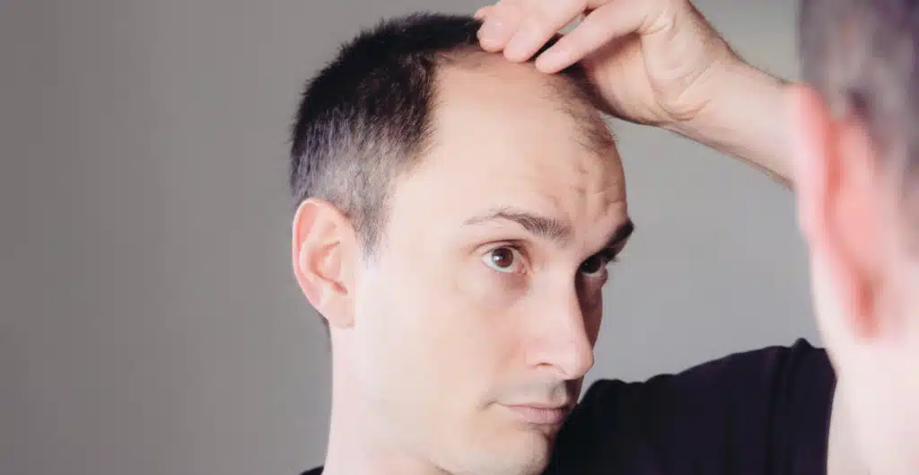 Male pattern baldness