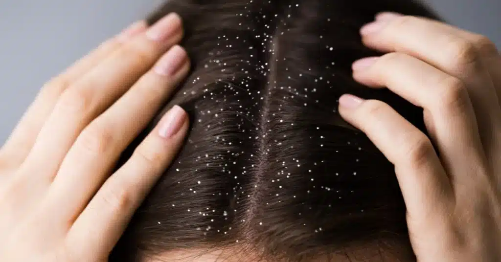 Scalp irritation during pregnancy
