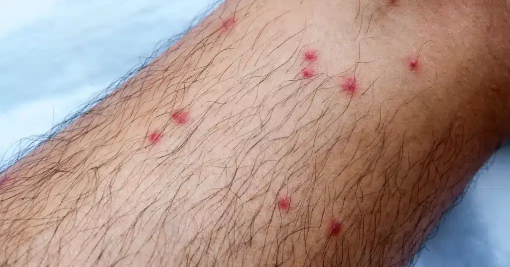 Alaskapox virus 