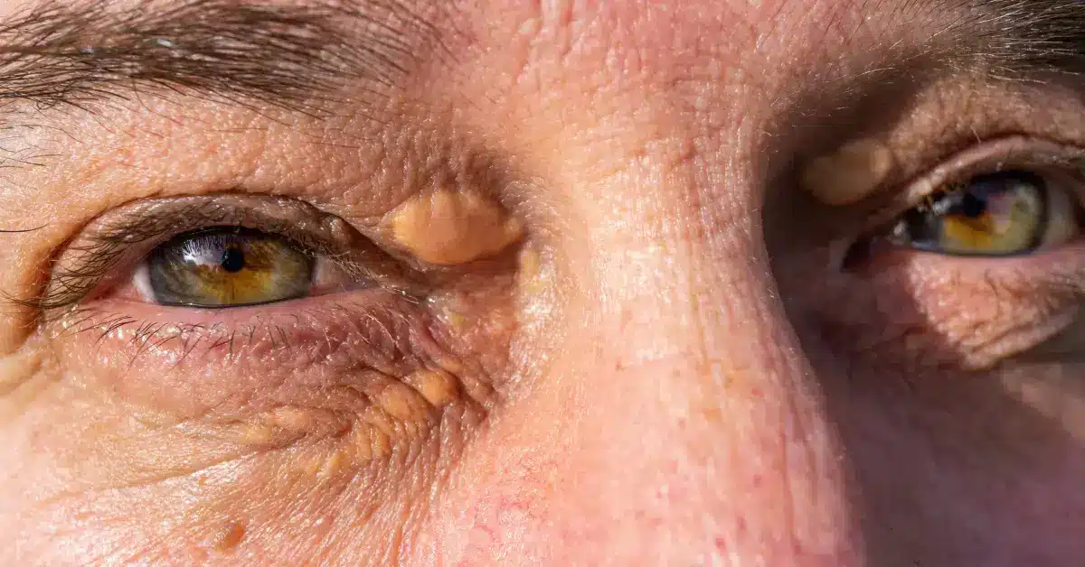 Cerulean Cataract