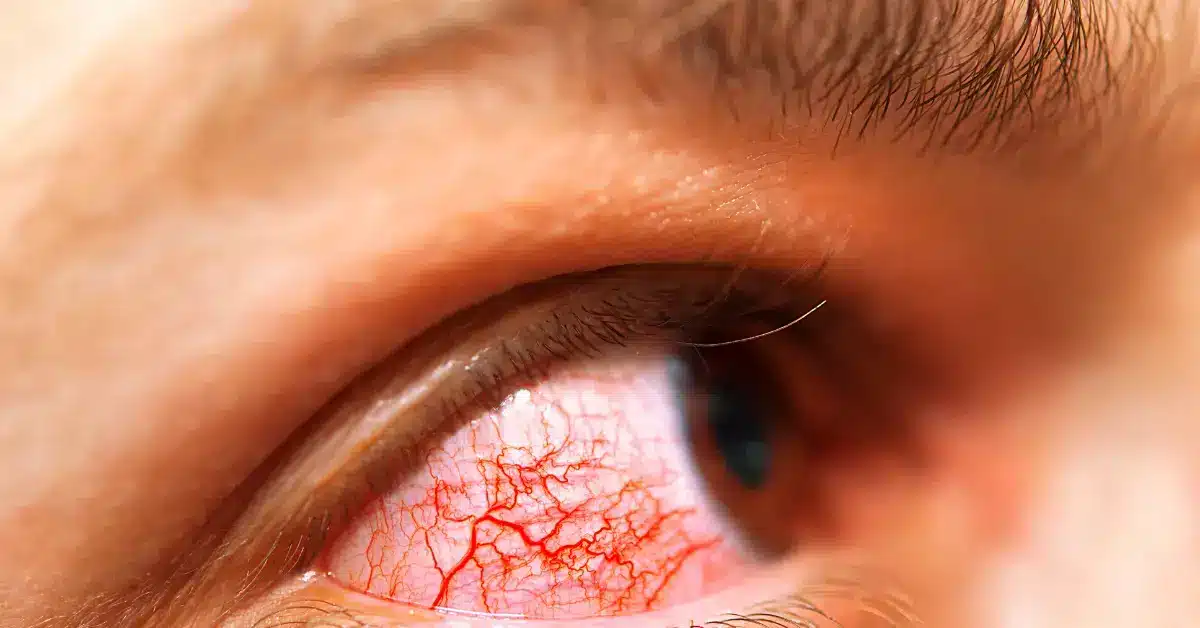 Closeup of a person with red eye allergies