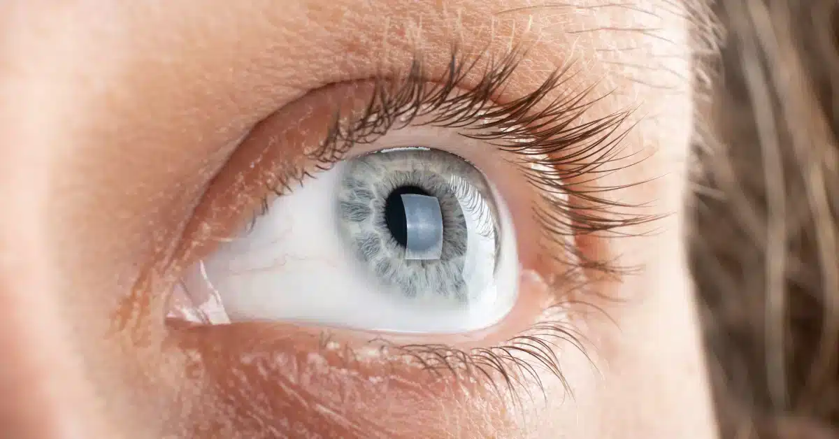Fungal Corneal Ulcer
