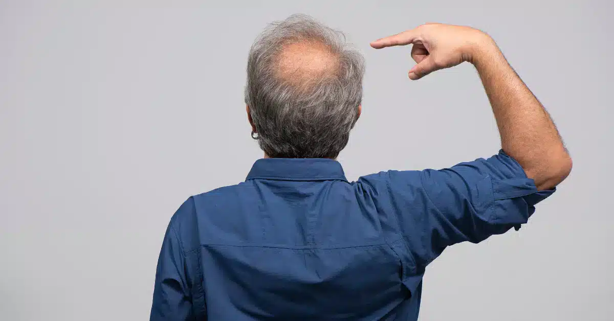 Onion Juice for Hair Regrowth in Male Pattern Baldness