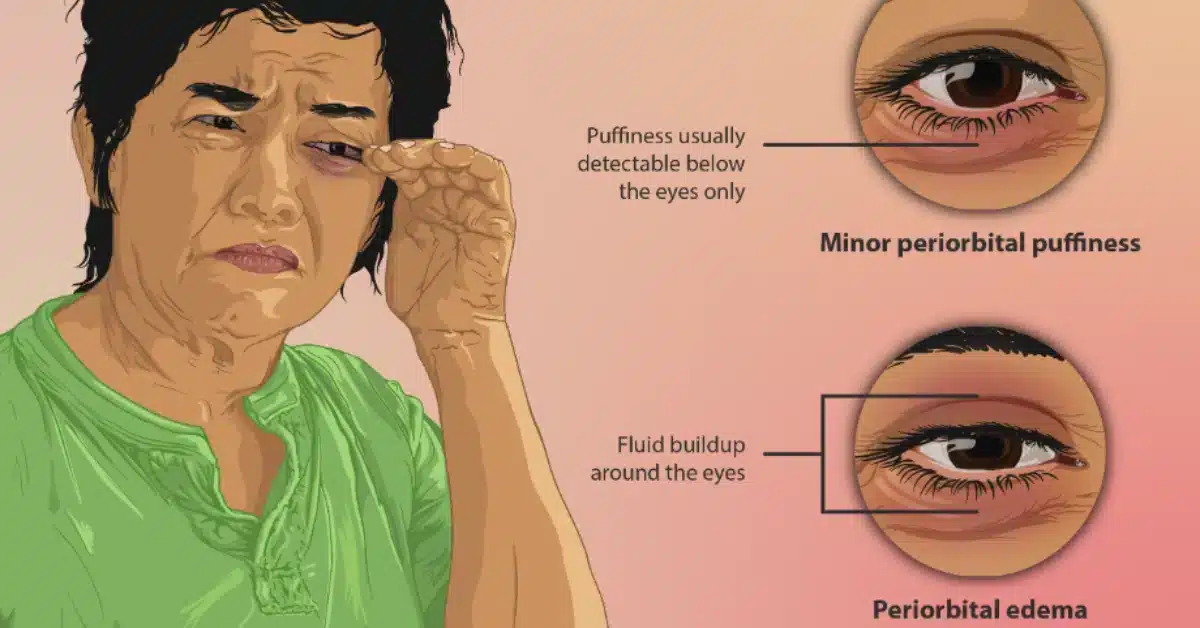 Swollen eye