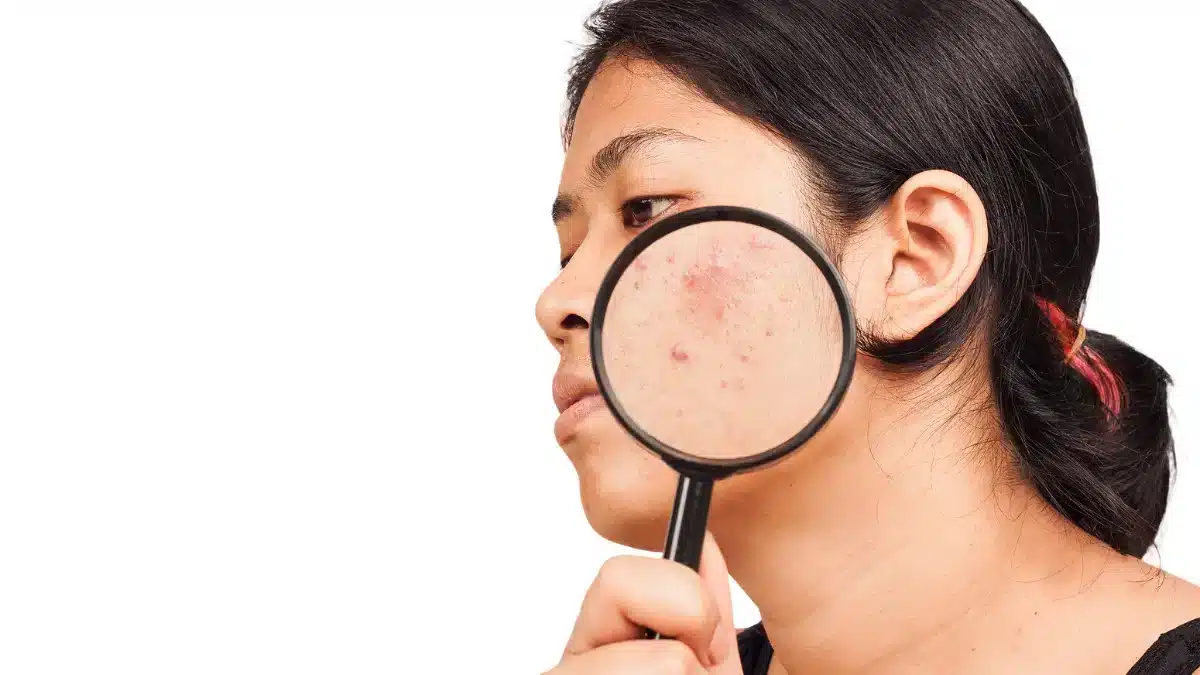 Acne After Stopping Birth Control Causes and Management