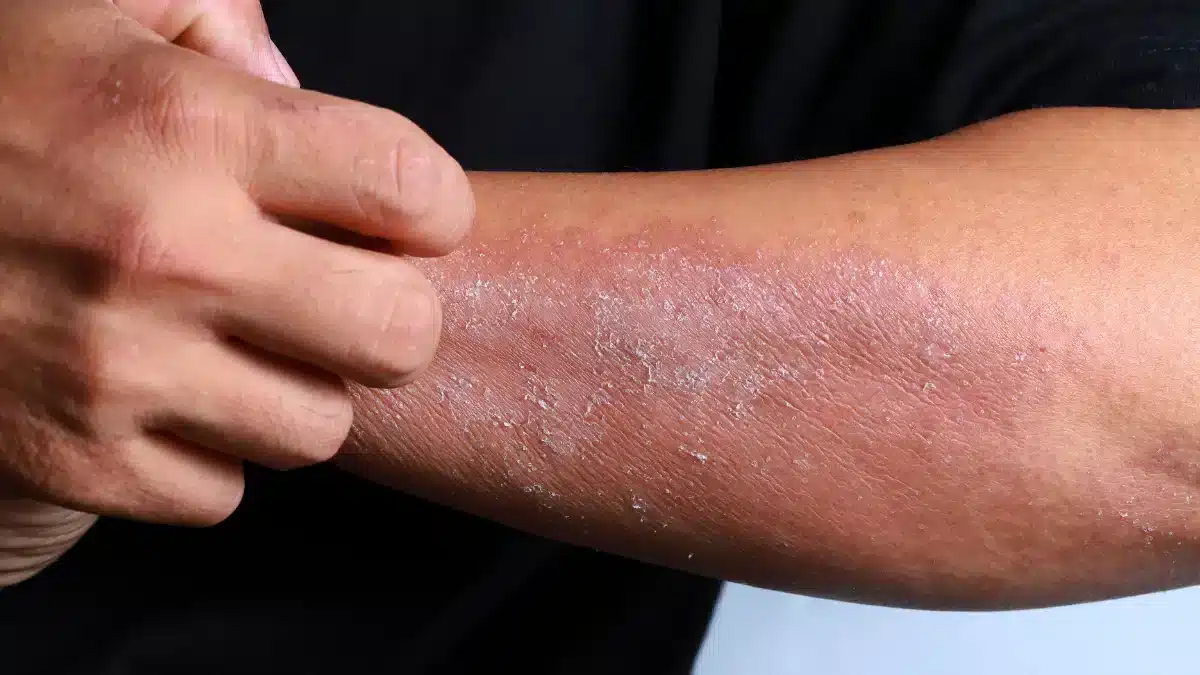 stds that cause dry skin