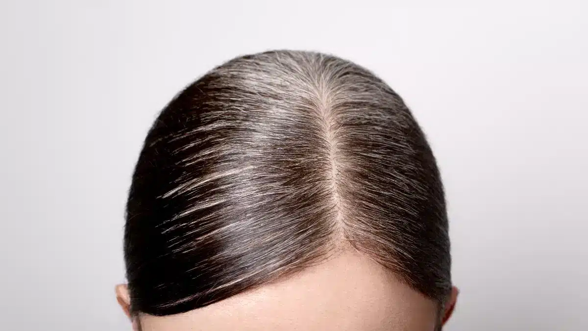 sudden change in texture of hair symptoms