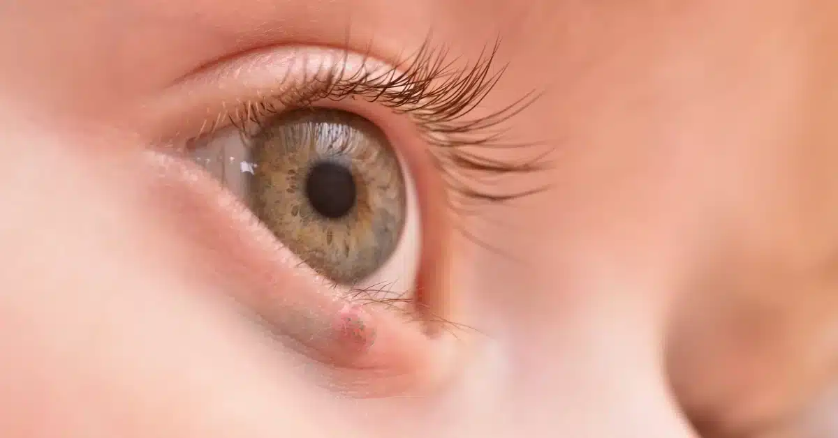 Why is my eyelid swollen (barley)